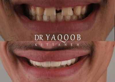زراعة اسنان اربد