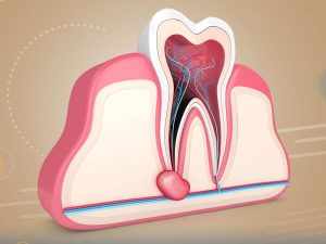 دكتور اسنان لازالة العصب